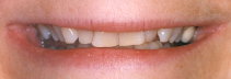CloseUpMouthBefore.jpg (22005 bytes)